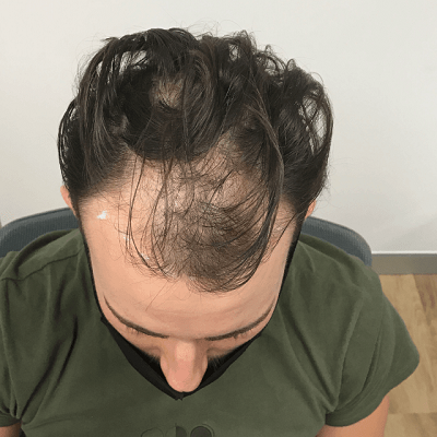 زراعة الشعر بالليزر في دبي وأبو ظبي تكلفة زراعة الشعر بالليزر