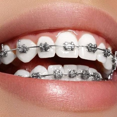 تقويم وتقويم الأسنان في دبي وأبو ظبي سعر الكلفة