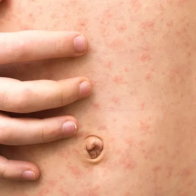 علاج أمراض الجلد في دبي وأبو ظبي اختبار مرض الجلد