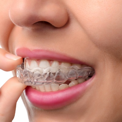 علاج تداخل الأسنان في دبي وأبو ظبي التكلفة المتداخلة