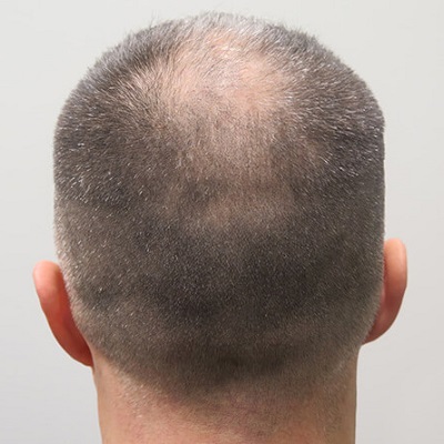 مراجعة زراعة الشعر في دبي وأبو ظبي والشارقة رويال