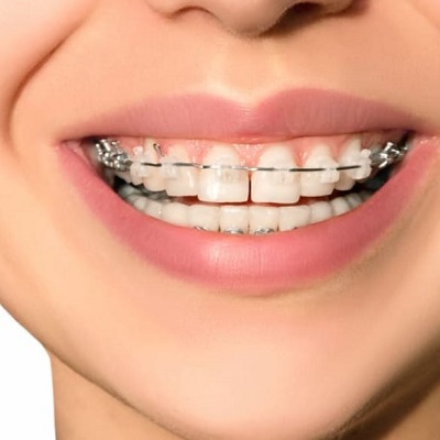 نظام تقويم الأسنان دامون في دبي وأبو ظبي تكلفة الأقواس الواضحة من دامون