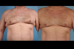 التثدي - تصغير الثدي عند الرجال في أبو ظبي