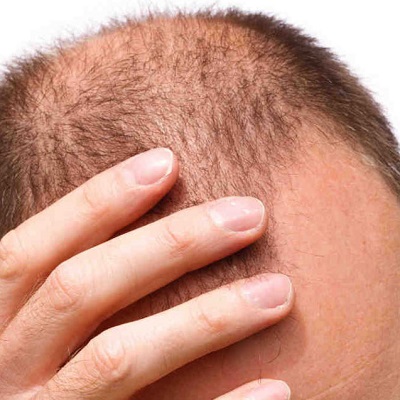 هل دبي مكان جيد لزراعة الشعر رويال كلينيك الامارات