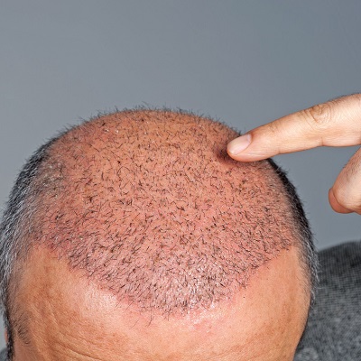 رسوم زراعة الشعر في دبي وأبو ظبي والشارقة سعر الكلفة