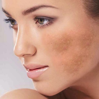 تكلفة علاج الكلف في دبي وأبو ظبي والشارقة سعر