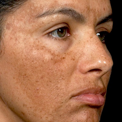 ما هو العلاج الأكثر فعالية للكلف في دبي وأبو ظبي