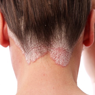 أفضل دكتور جلدية في دبي وأبو ظبي والشارقة لمرض الصدفية