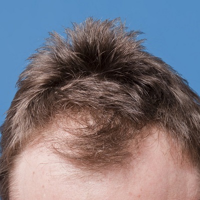 زراعة الشعر لتساقط الشعر الوراثي دبي