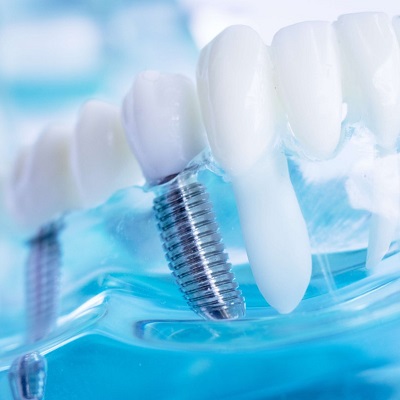 ماذا تتوقع خلال علاج زراعة الأسنان؟