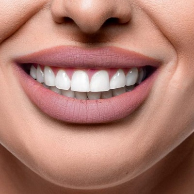 ابتسامة هوليوود المذهلة في دبي وأبو ظبي والشارقة سعر التكلفة