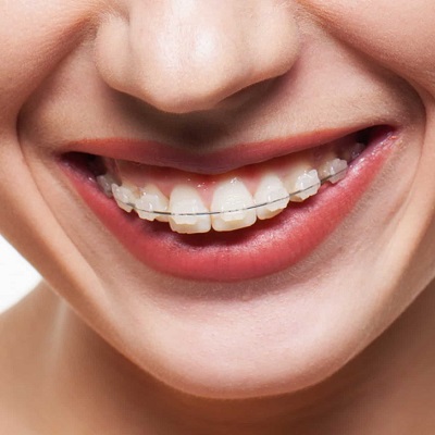 ما هي فوائد تقويم الأسنان الخزفي في دبي وأبو ظبي والشارقة يكلف