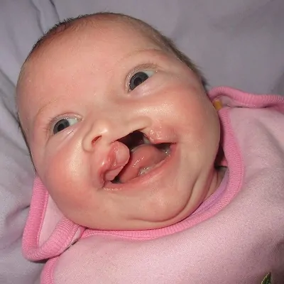 ماذا تحتاج لمعرفته حول الشفة الأرنبية والحنك المشقوق في دبي يكلف