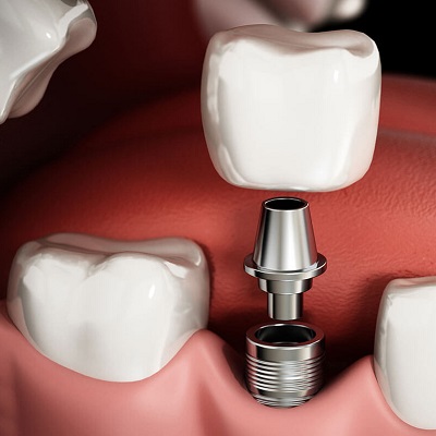 كم من الوقت يستغرق التعافي من جراحة زراعة الأسنان؟