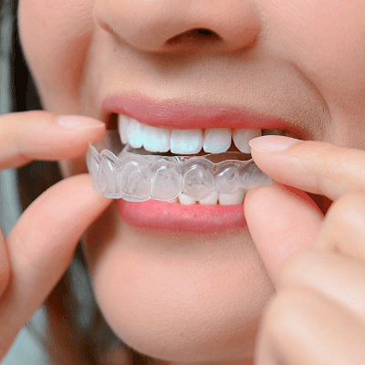 كيف يعمل تقويم الأسنان في دبي وأبو ظبي والشارقة سعر الكلفة