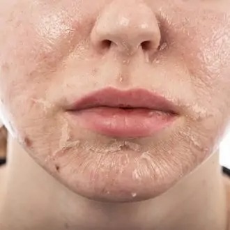 الدليل النهائي علاج تقشير الكوزميلان في دبي وأبو ظبي