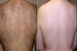 عيادات إزالة الشعر بالليزر للرجال في دبي