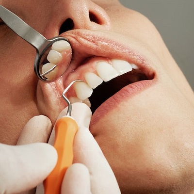 ماذا يحدث إذا بقي جذر في الأسنان في دبي؟