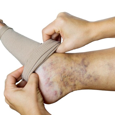 هل يمكن أن تسبب علاجات الدوالي جلطات الدم رويال كلينيك
