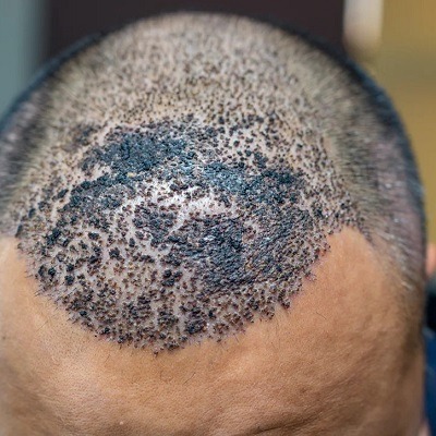 هل يمكنني الإصابة بالعدوى بعد زراعة الشعر في دبي؟