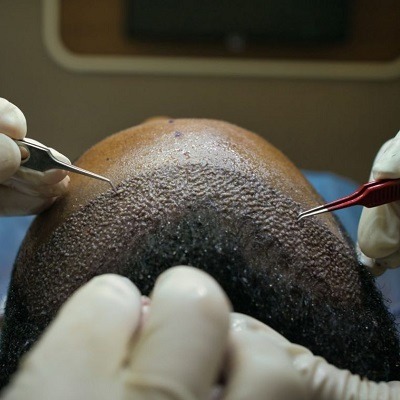 إجراءات زراعة الشعر المتقدمة في دبي