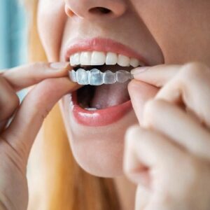 10 حقائق مثيرة للاهتمام حول علاج قناة الجذر في دبي