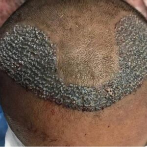 زراعة الشعر يمكن أن تغير من ثقتك بنفسك