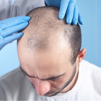 أفضل الممارسات لمرضى FUT