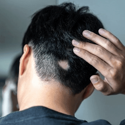 العلاجات الطبيعية لمرض الثعلبة البقعية هل هي فعالة