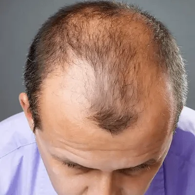 كيف يمكن FUSS لزراعة الشعر استعادة خطوط الشعر بشكل فعال؟