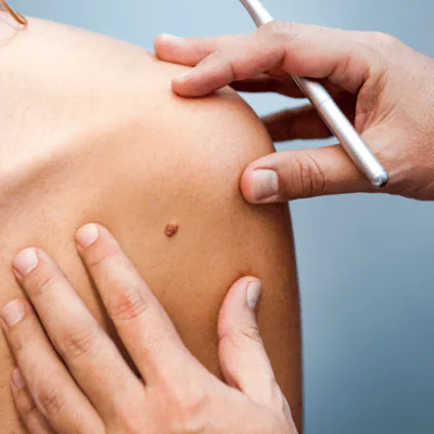 ما مدى فعالية العلاج بالتبريد للثآليل؟