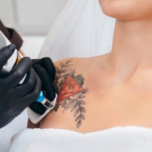 هل يمكن أن يسبب إزالة الوشم بالليزر ظهور بثور؟