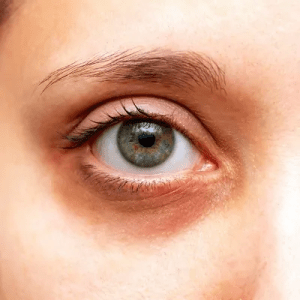 ما الذي يسبب ظهور الهالات السوداء تحت العينين؟