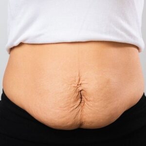 هل يترهل الجلد بعد عملية شفط الدهون؟