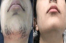 إزالة الشعر بالليزر الدائم