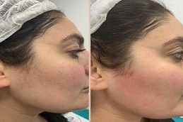 تقنية الليزر لإزالة الشعر