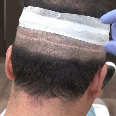 تكلفة زراعة الشعر في دبي تبدأ من 6,999 درهم
