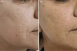 تمويه الندوب في أبوظبي