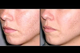 تمويه الندوب في الإمارات العربية المتحدة