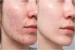 تمويه الندوب في دبي