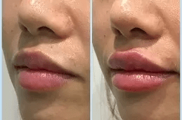 جراحة تجميلية متقدمة