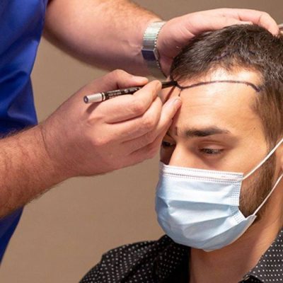 زراعة الشعر للرجال في دبي حل دائم للصلع
