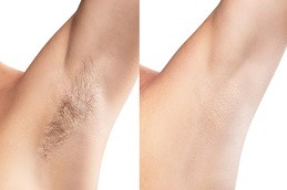 عيادات إزالة الشعر بالليزر