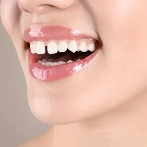 هل يمكن لتركيبات الأسنان التجميلية أن تسد الفراغات بين الأسنان؟