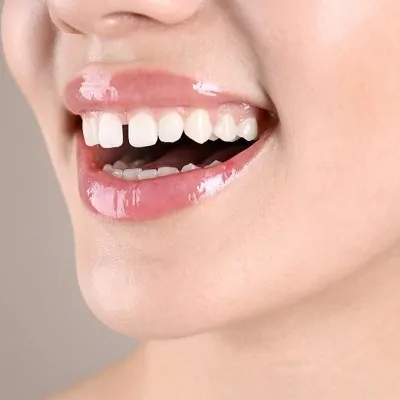 هل يمكن لتركيبات الأسنان التجميلية أن تسد الفراغات بين الأسنان؟