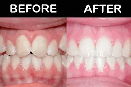 مقومات الأسنان لترميم الأسنان المفقودة