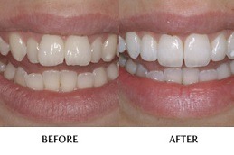 مقومات الأسنان والتجميل السني