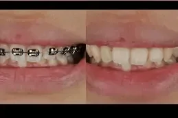 ٢. أجهزة تقويم الأسنان بدبي