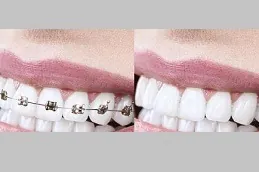 ٣. علاج تقويم الأسنان في دبي