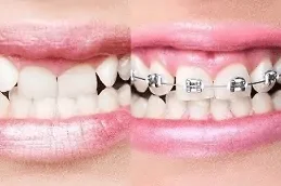 ٦. تركيب تقويم الأسنان في دبي